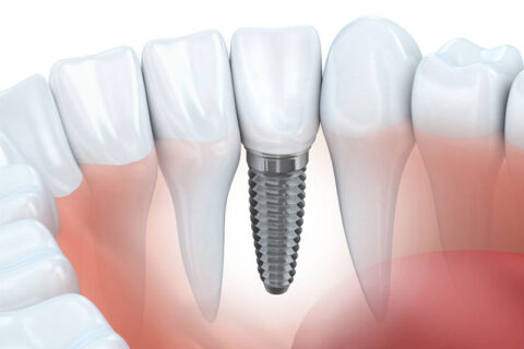 dental implant procedure