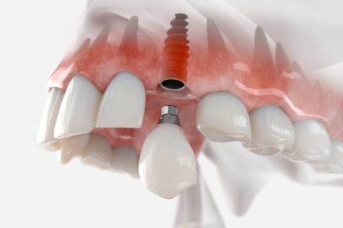 Dental Implant