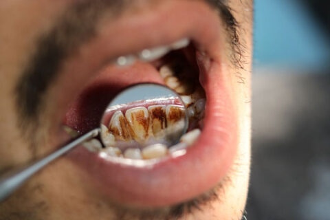 Man going through Oral Cancel Screening