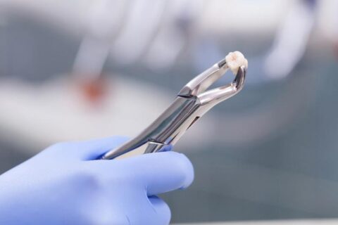 Tooth Extraction