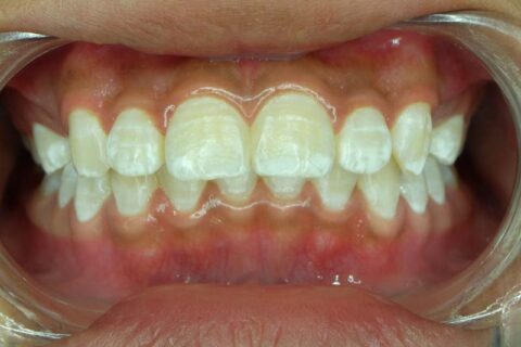 White Spots on the teeth